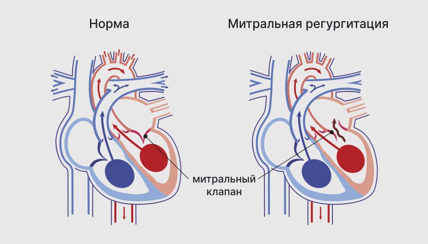 prolaps-mitralnogo-klapana-oslozhneniya.jpg